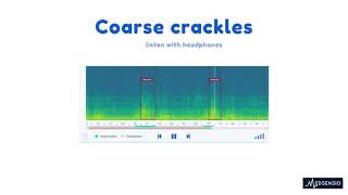 Lung sounds  coarse crackles [upl. by Rahas]