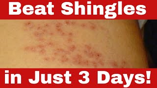 How to Cure Shingles in 3 Days  Simple Proven Home Remedies [upl. by Doley]