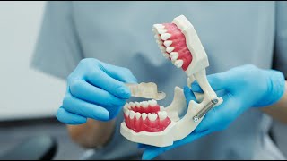 A Novel Technique for the Fabrication of Maxillary Obturator Using Combination of PEEK [upl. by Acinoreb]