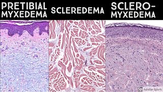 Pretibial Myxedema vs Scleredema vs Scleromyxedema  Dermatopathology quotSoundAlikesquot [upl. by Meihar]