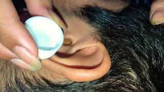 DESRAPANDO oido de niño con agua oxigenada  Ear wax removal [upl. by Wrand]