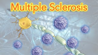 Multiple Sclerosis MS Clearly Explained  MADE EASY [upl. by Eirb]