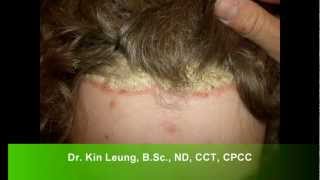 Dr Kin Leung Naturopathic Case Review Patient with Psoriasis Vulgaris plaque silver scales on scalp [upl. by Llerdnod]