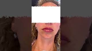 LIP FILLER MAGIC FirstTime Client Results aobmedspa medspa lipfiller [upl. by Ecnar]