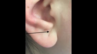 PCOS and earlobe creases Franks sign [upl. by Gambrill]