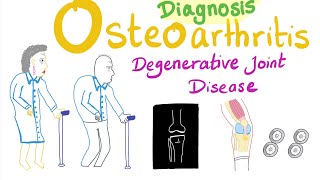 Osteoarthritis OA  Diagnosis  Rheumatology Series [upl. by Hoon]