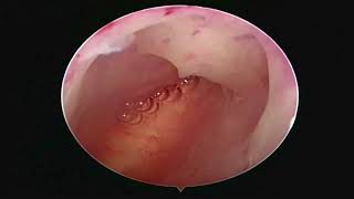 Histeroscopía de consultorio PATRON ENDOMETRIAL ATROFICO  OBSTRUCCION TUBARICA BILATERAL [upl. by Alpert]