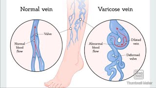 varicose vein part 1 [upl. by Tenenbaum598]