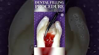 Dental Filling Procedure Cavity Filling dental dentist cavityfilling medical medicine shorts [upl. by Tterrab]