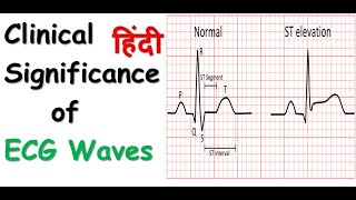 Clinical Significance of ECG Waves segment and intervals in Hindi [upl. by Curson]