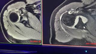 Complejo de buford lesión de labrum y ligamentos de hombro [upl. by Demha393]