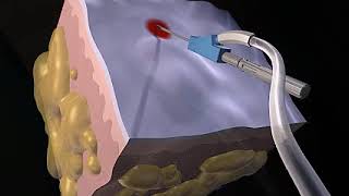 How Liposuction Works Animation  Liposuction Procedure Video [upl. by Lilia]