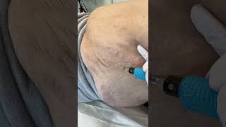 Stretch Marks Inkless Removal Boleyn Treatment Los Angeles 🌍 shorts [upl. by Ardisj]