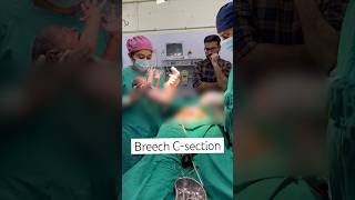 Breech Cesarean Section breechbaby cesareanbirth csection babyoutcome delivery [upl. by Seif]