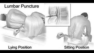 Mnemonics to remember structures pierced during Lumbar Puncture [upl. by Delaney]