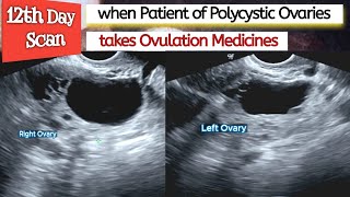 Ovarian CYSTS  Ovulation Medicines in PCOS Patient  Polycystic Ovaries  Infertility [upl. by Sumer]