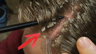 lift up scalp flakes w intense psoriasis scratching you need after this vote🇺🇸 [upl. by Ahsrop84]