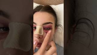 NOSE JOB VLOG  DAY 1 😳 [upl. by Lundberg]