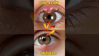 Chalazión vs Orzuelo orzuelo chalazion Tratamiento oftalmologia infeccionOcular [upl. by Assir]