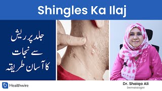 Shingles Ka Ilaj – Shingles Treatment in UrduHindi [upl. by Aneehsak]