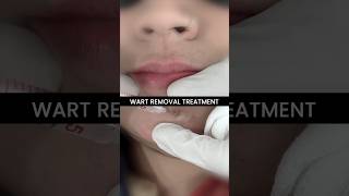 How to Get Wart Removed Treatment and Procedure at Skinaa Clinic viral shorts [upl. by Durnan]