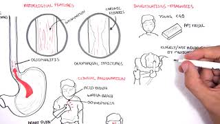 GORD GERD Gastro Oesophageal Reflux Disease  Overview pathophysiology treatment [upl. by Avelin]