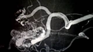 AVM embolization Vanderbilt Neurovascular Surgery [upl. by Strenta]