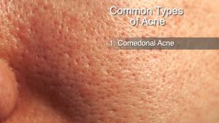 How to Treat Different Types of Acne [upl. by Lisa]