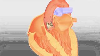 CoreValve  Transcatheter Aortic Valve Replacement by Medtronic [upl. by Einehpets]