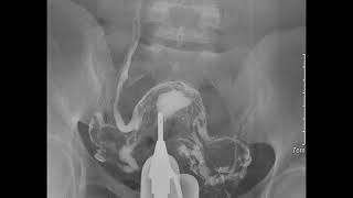 CASE 143 HSG VENOUS INTRAVASATION VERSUS CONTRAST SPILLAGE [upl. by Rubel]