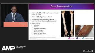 Dr Joseph Blas Infrapopliteal Occlusion Successfully Treated with Pounce™ Thrombectomy System [upl. by Gothard]