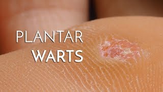 Plantar Warts Verrucas  Podiatrist Georgina Tay East Coast Podiatry [upl. by Otrebmuh]