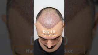 8Month Hair Transplant Results in Istanbul hairtransplant hairtransformation healthtourism [upl. by Lam994]