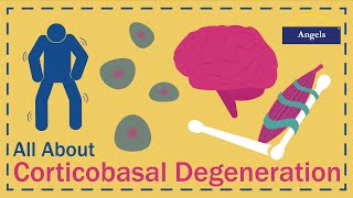 All About Corticobasal Degeneration [upl. by Lough]