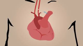 Embolic Stroke [upl. by Stewart357]