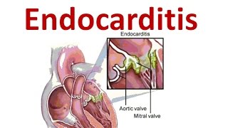 Endocarditis [upl. by Nyrhtac]