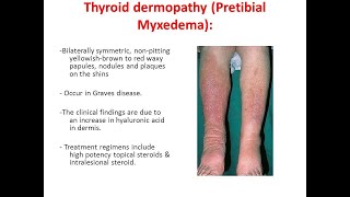 Clinical presentations of Myxedema resulting from Graves disease [upl. by Eilarol]