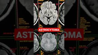 Imaging Tumors  Astrocytoma [upl. by Ielarol]