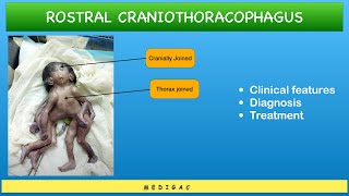 Conjoined Twins  Craniothoracophagus  Clinical features  Diagnosis  Treatment [upl. by Canada686]