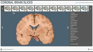 Neuroanatomy  Basal Ganglia in Brain Cross Sections [upl. by Hawkie441]