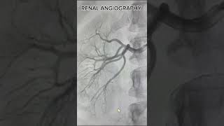 Why might I need a renal angiography [upl. by Kosak]