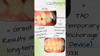 Correction of dental flaring or protrusion and a Class II bite with TADs amp braces braces sanramon [upl. by Llevra]