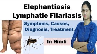 Elephantiasis  Filariasis  Symptoms Causes Diagnosis Treatment Prevention  In Hindi [upl. by Tem]