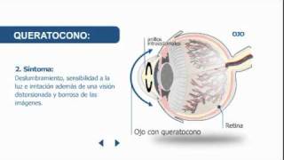 Síntomas y tratamiento del queratocono  Clínica Baviera [upl. by Dympha]