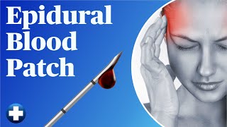 Spinal Headache Epidural Blood Patch StepByStep [upl. by Atoiyanap381]