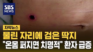 물린 자리에 검은 딱지…quot온몸 퍼지면 치명적quot 환자 급증 자막뉴스  SBS [upl. by Fraya576]