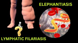 Lymphatic Filariasis Elephantiasis Causes Life Cycle and Treatment elephantiasis filariasis [upl. by Finah]