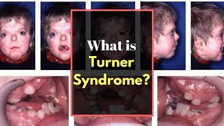 Turner syndrome Symptoms  Causes Pictures Signs and Symptoms of Turners syndrome [upl. by Pyszka]