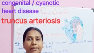 congenital cyanotic heart disease truncus arteriosis class in tamil [upl. by Byron]