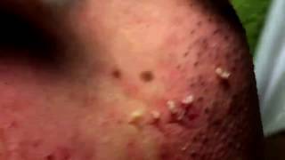 Acne Solution  Blackheads amp Whiteheads Removal 1  How to get rid of acne [upl. by Enillebyam]